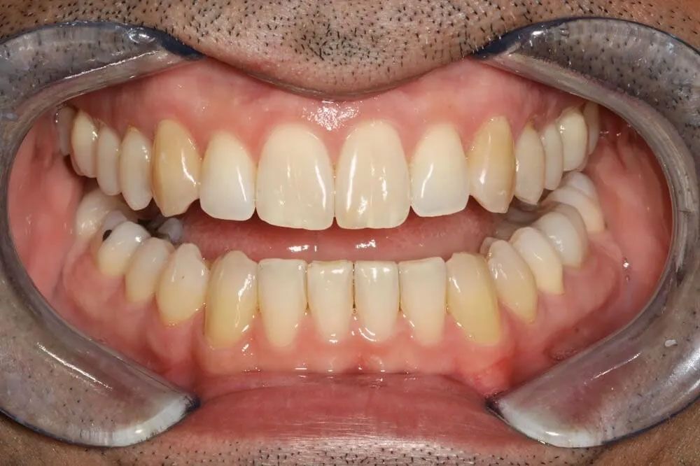 A close up of a person 's teeth with a mouth guard.