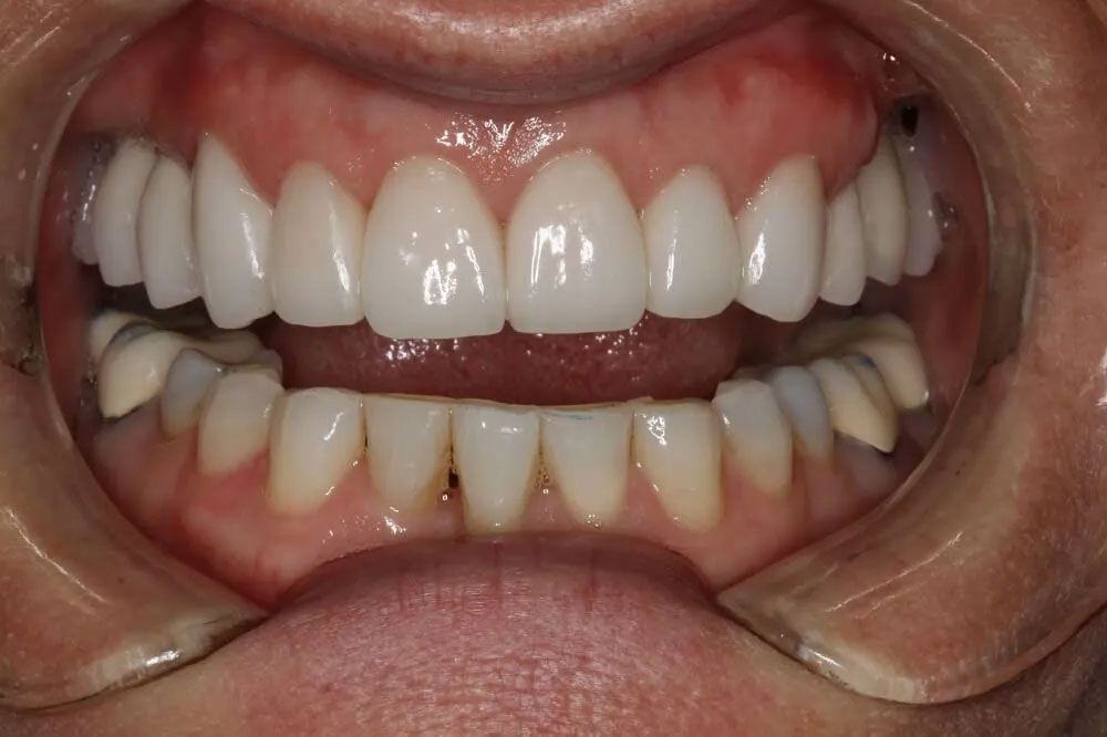 A close up of a person 's mouth with white teeth.