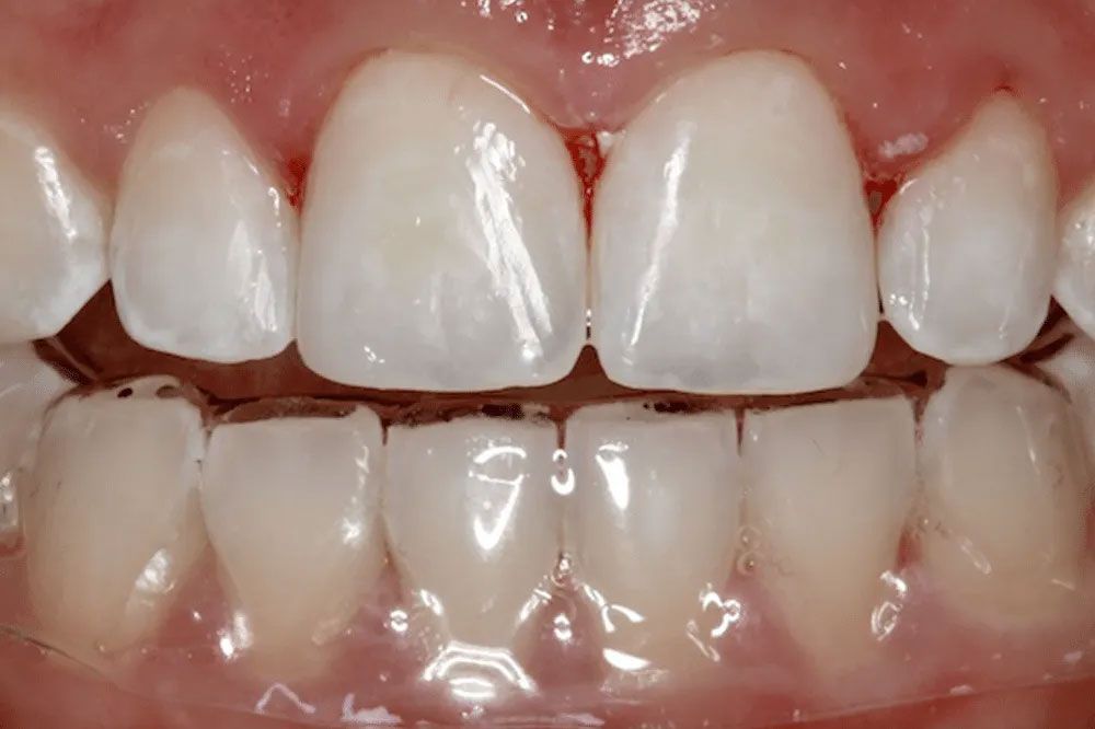 A close up of a person 's teeth with a clear brace.