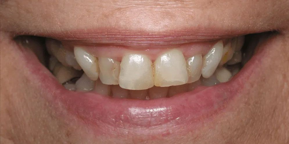 A close up of a person 's mouth with a missing tooth.