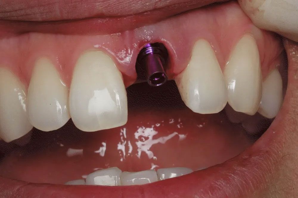 A close up of a person 's mouth with a dental implant in it.