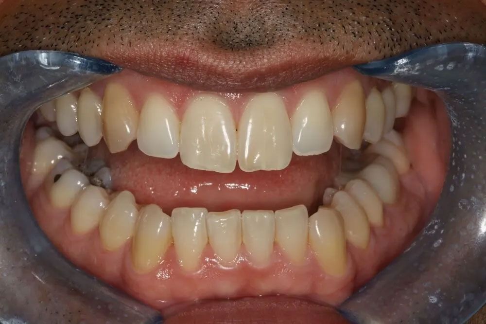 A close up of a man 's teeth with a clear mouth guard.