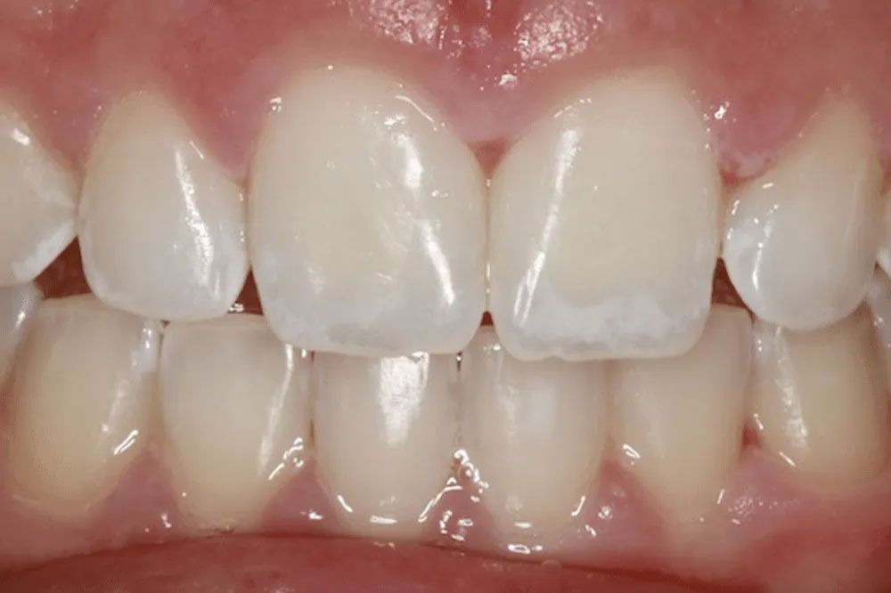 A close up of a person 's teeth with white spots on them.