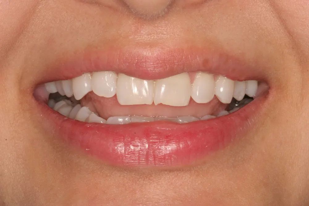 A close up of a woman 's mouth with a broken tooth.