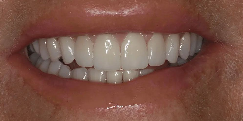 A close up of a person 's smile with white teeth.