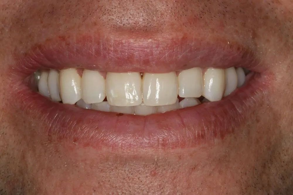 A close up of a man 's mouth with white teeth.