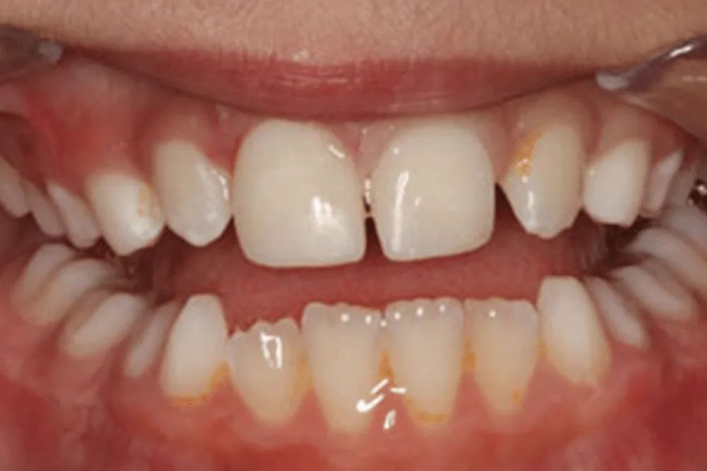 A close up of a person 's teeth with a missing tooth.