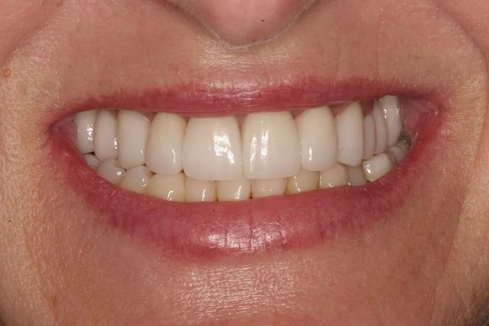 A close up of a woman 's smile with white teeth.