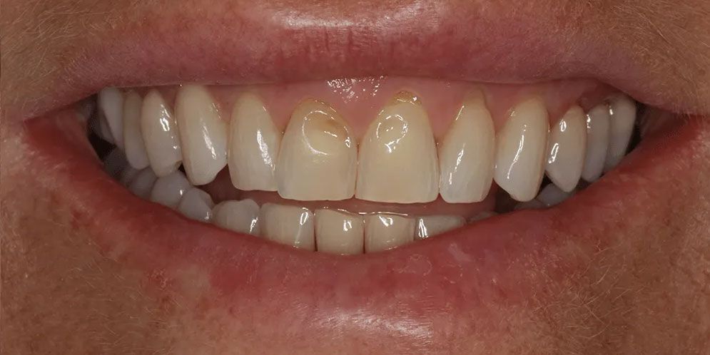 A close up of a person 's mouth with white teeth.