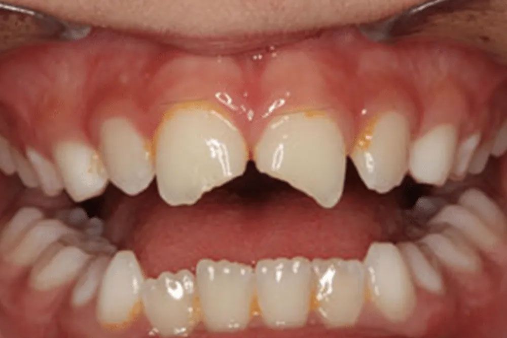 A close up of a person 's teeth with a broken tooth.