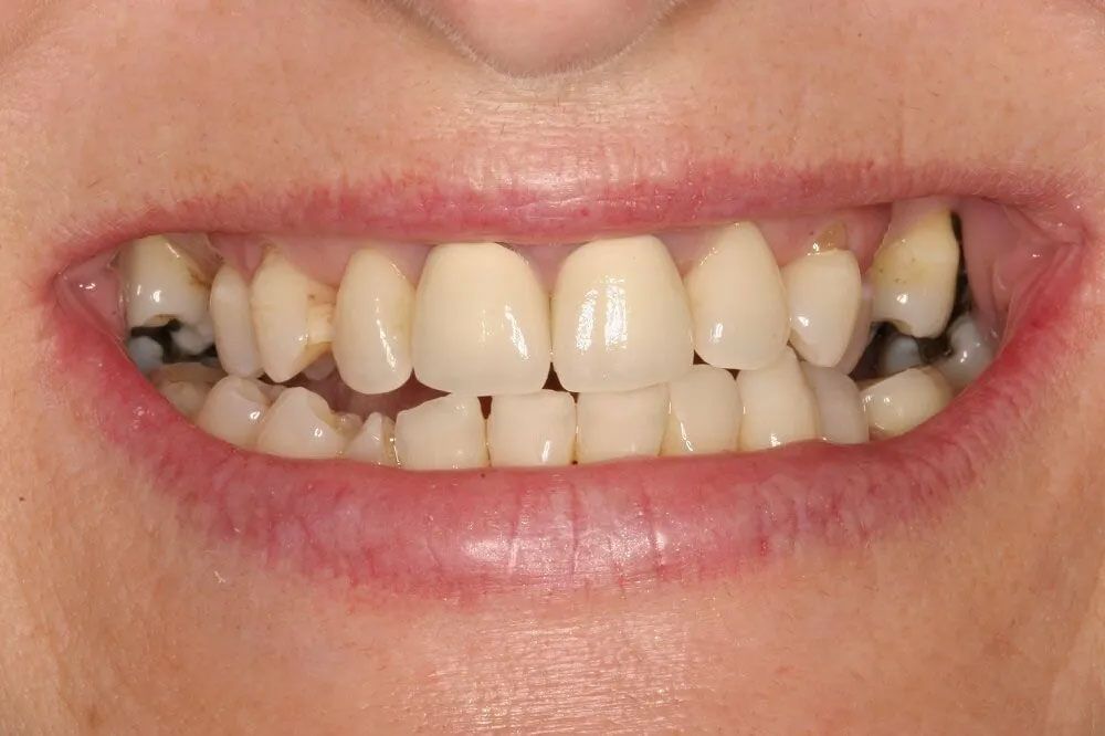 A close up of a woman 's teeth with a lot of missing teeth.