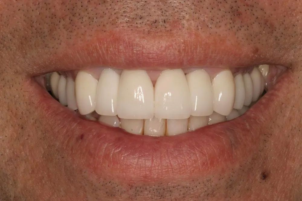 A close up of a man 's smile with white teeth.