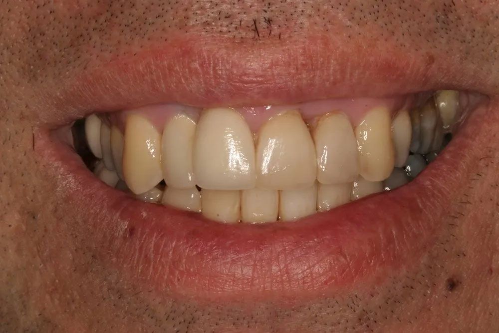 A close up of a man 's mouth with his teeth showing.