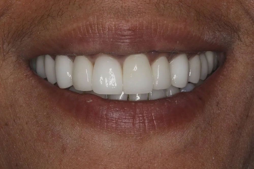 A close up of a person 's smile with white teeth.