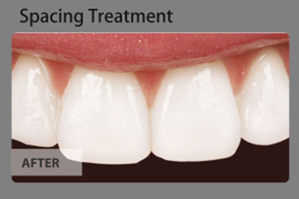 A picture of a person 's teeth before and after a spacing treatment