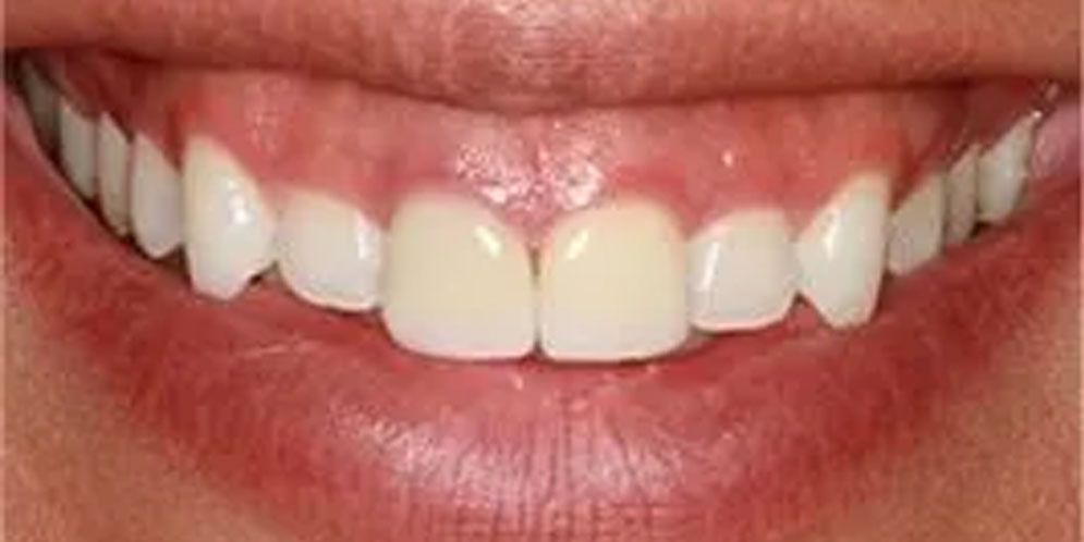A close up of a person 's smile with white teeth.