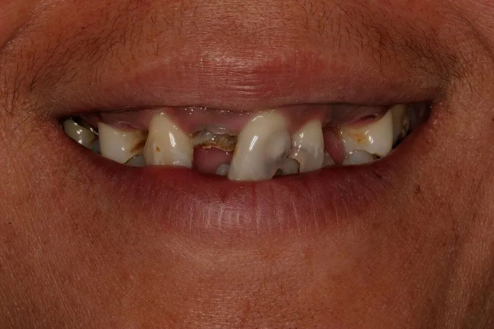 A close up of a man 's mouth with missing teeth.