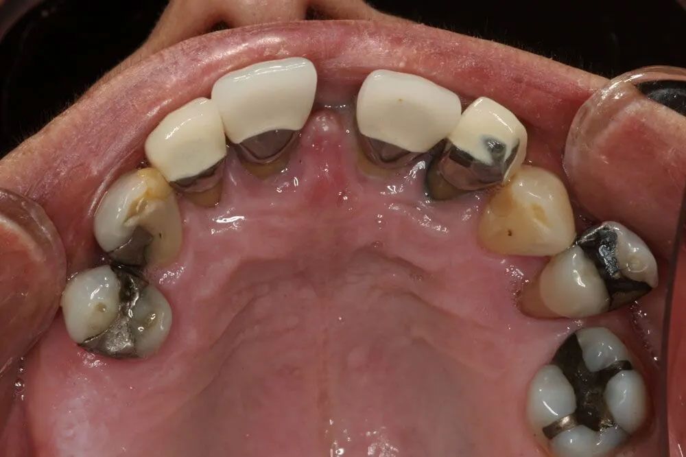 A close up of a person 's mouth with a lot of teeth.