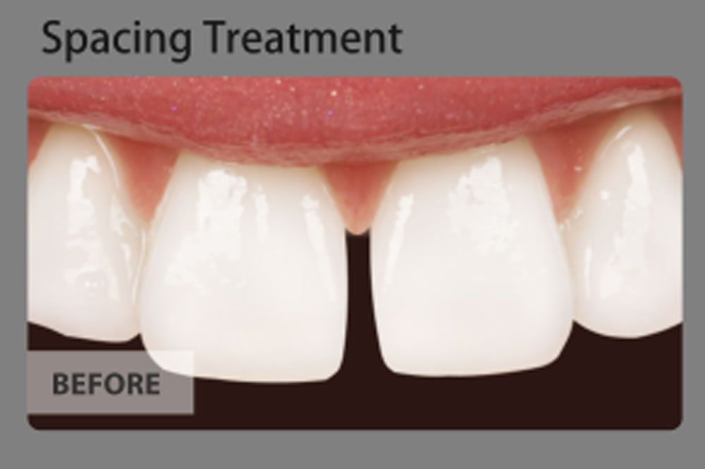 A picture of a person 's teeth before a spacing treatment