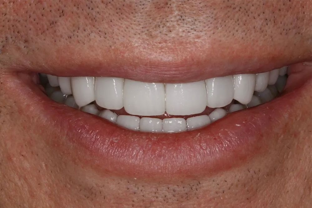 A close up of a man 's smile with white teeth.