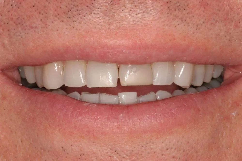 A close up of a man 's teeth with a missing tooth.