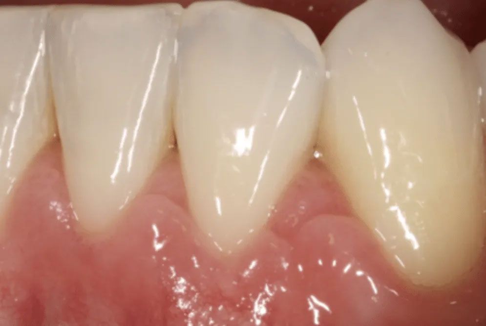 A close up of a person 's teeth and gums.