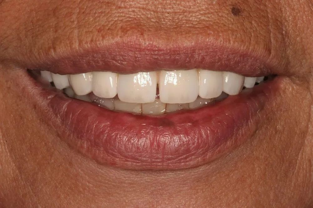 A close up of a woman 's smile with white teeth.
