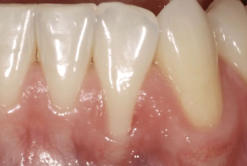 A close up of a person 's teeth and gums.