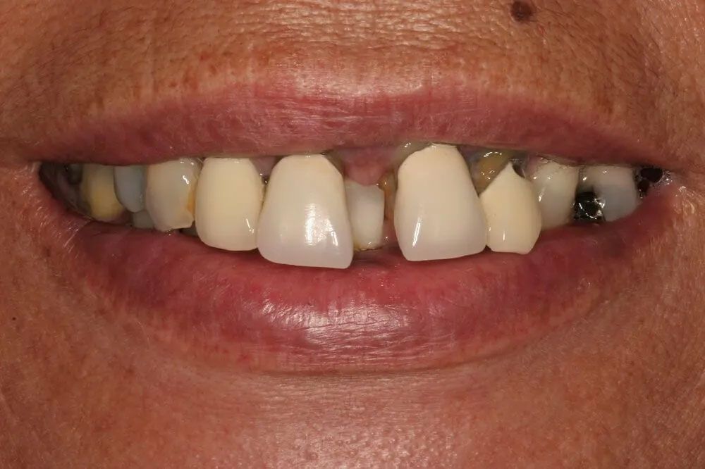 A close up of a woman 's mouth with missing teeth.