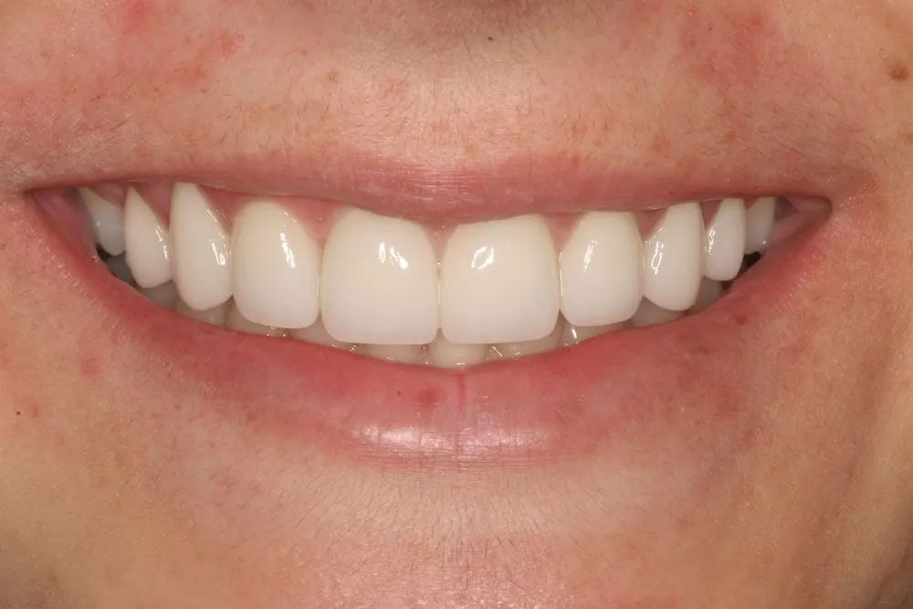 A close up of a woman 's smile with white teeth.