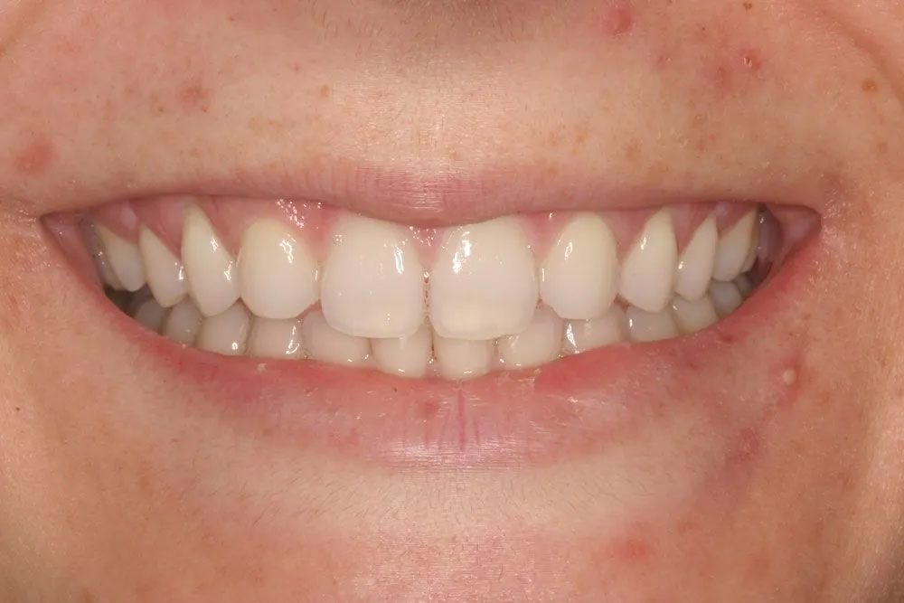 A close up of a person 's teeth with a smile on their face.