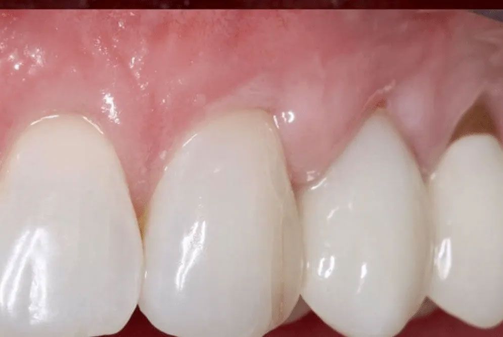 A close up of a person 's teeth and gums.