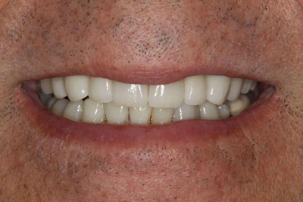 A close up of a man 's mouth with white teeth.
