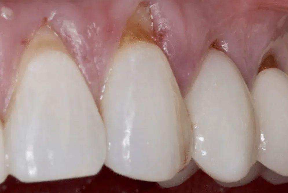 A close up of a person 's teeth with plaque on them.