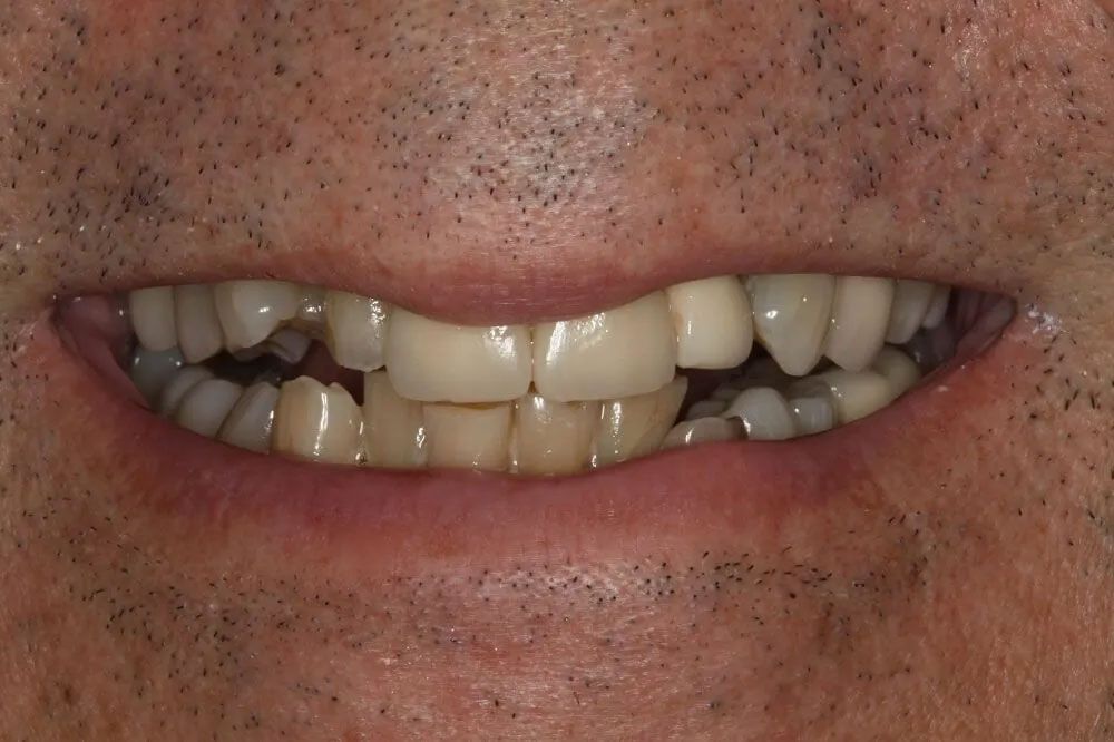 A close up of a man 's mouth with missing teeth.