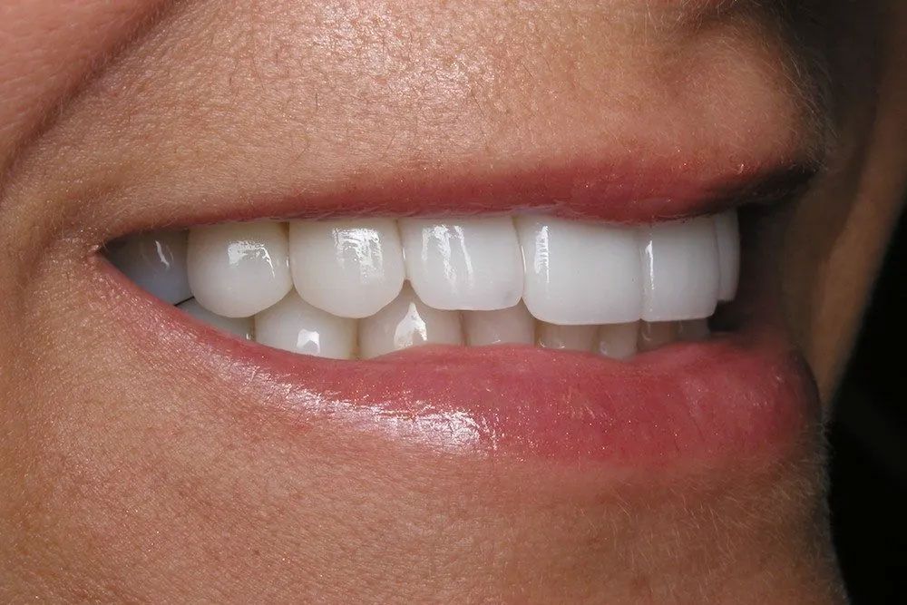 A close up of a woman 's smile with white teeth.