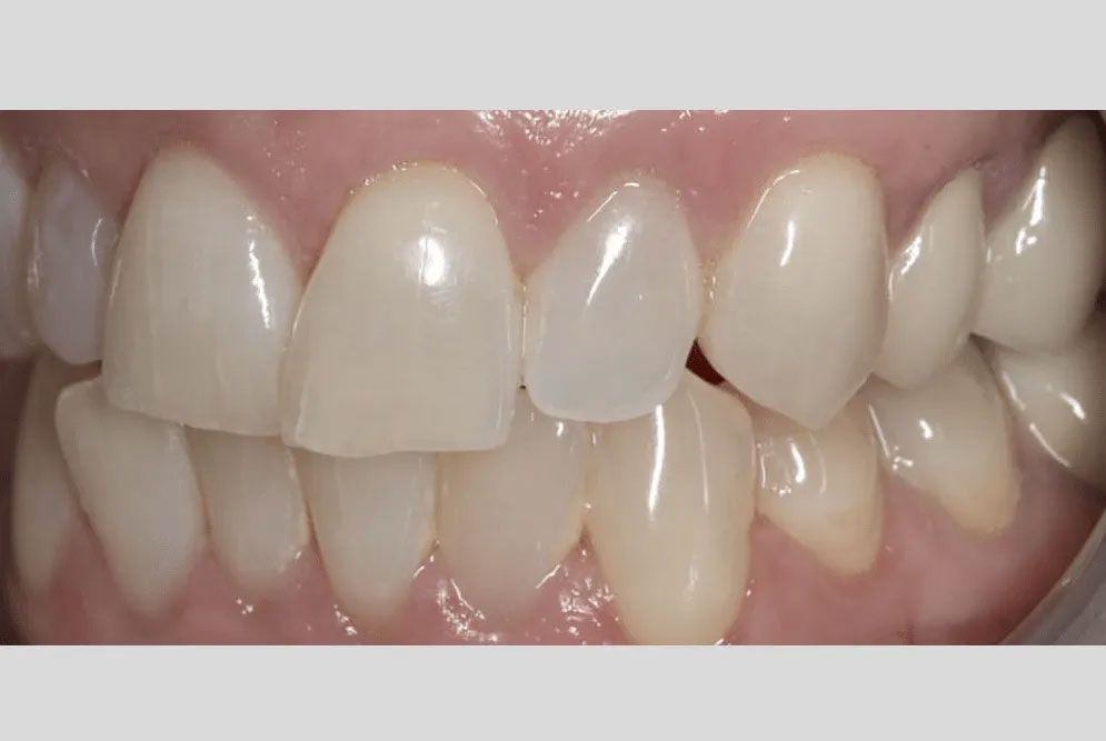 A close up of a person 's teeth with white teeth.