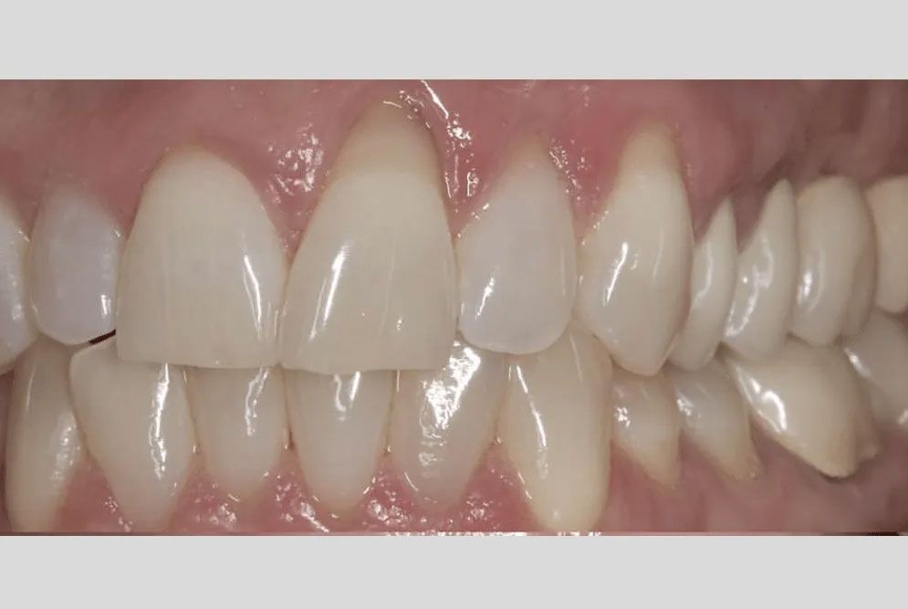 A close up of a person 's teeth with white teeth.