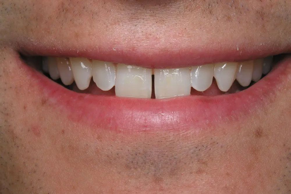 A close up of a man 's teeth with a missing tooth.