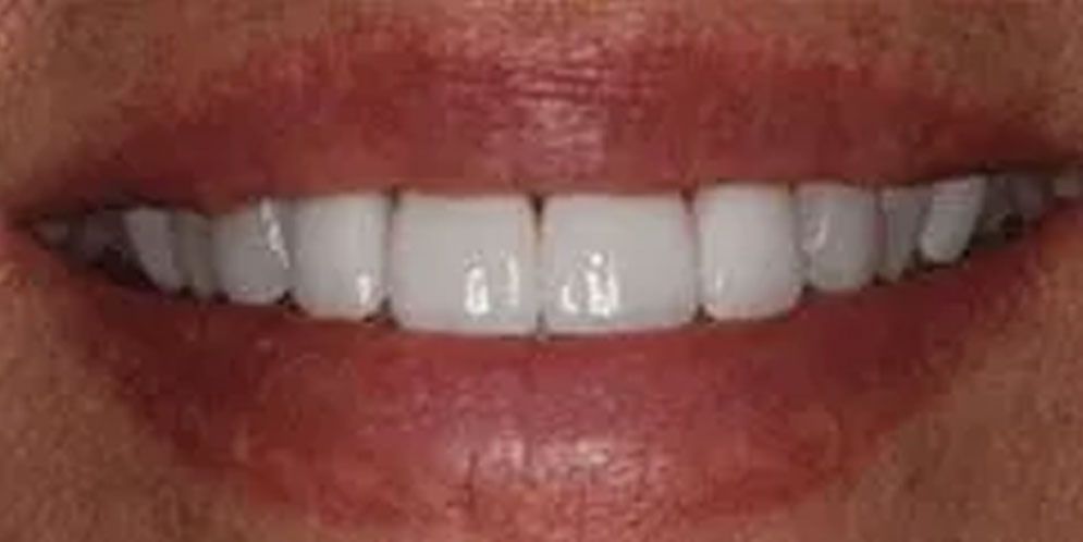 A close up of a person 's mouth with white teeth.