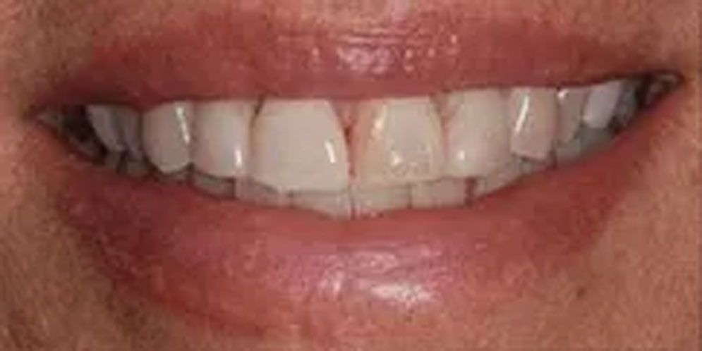 A close up of a person 's smile with white teeth.