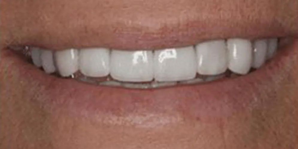 A close up of a person 's smile with white teeth.