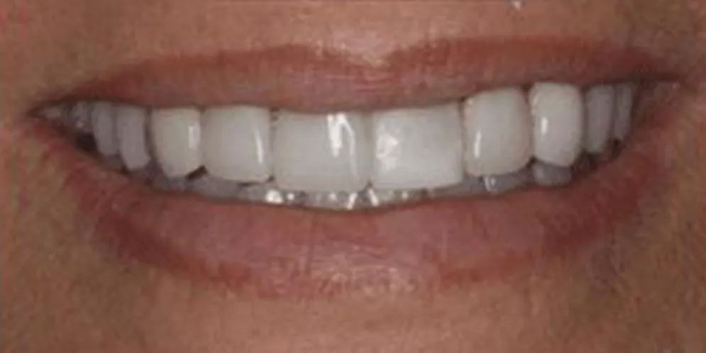 A close up of a person 's smile with white teeth.