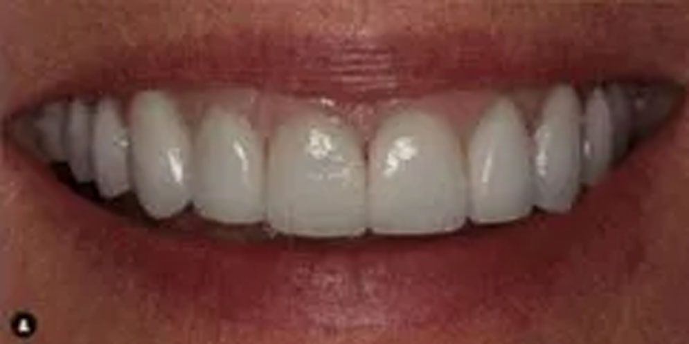 A close up of a person 's smile with white teeth.