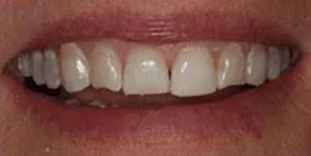 A close up of a person 's mouth with white teeth.