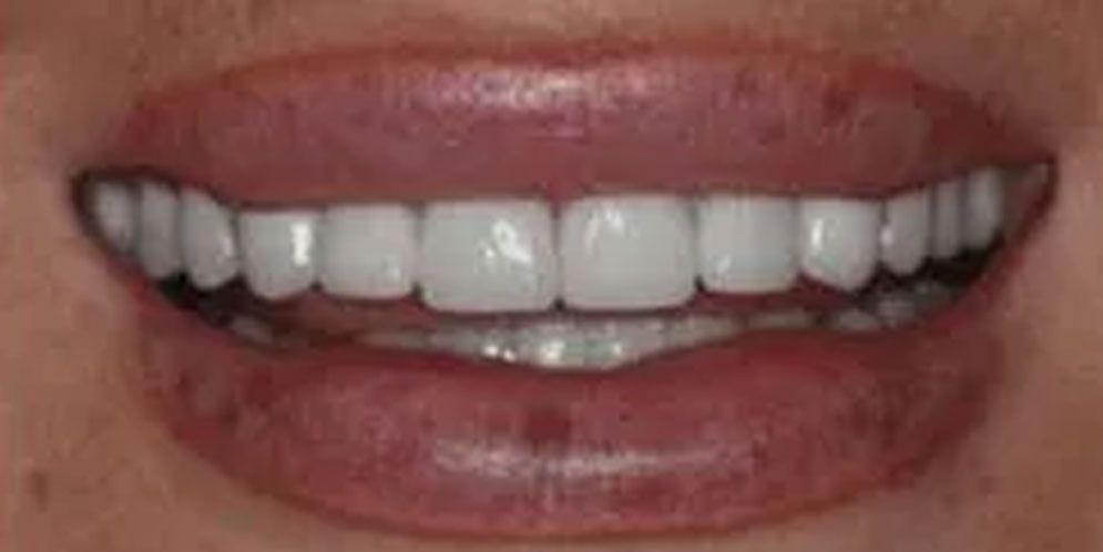 A close up of a woman 's smile with white teeth.