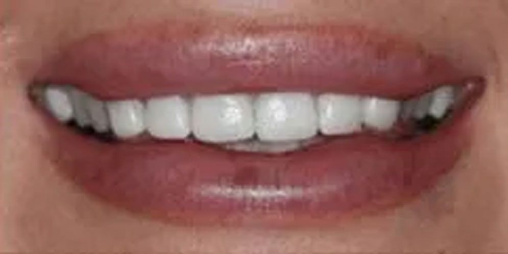 A close up of a woman 's mouth with white teeth.
