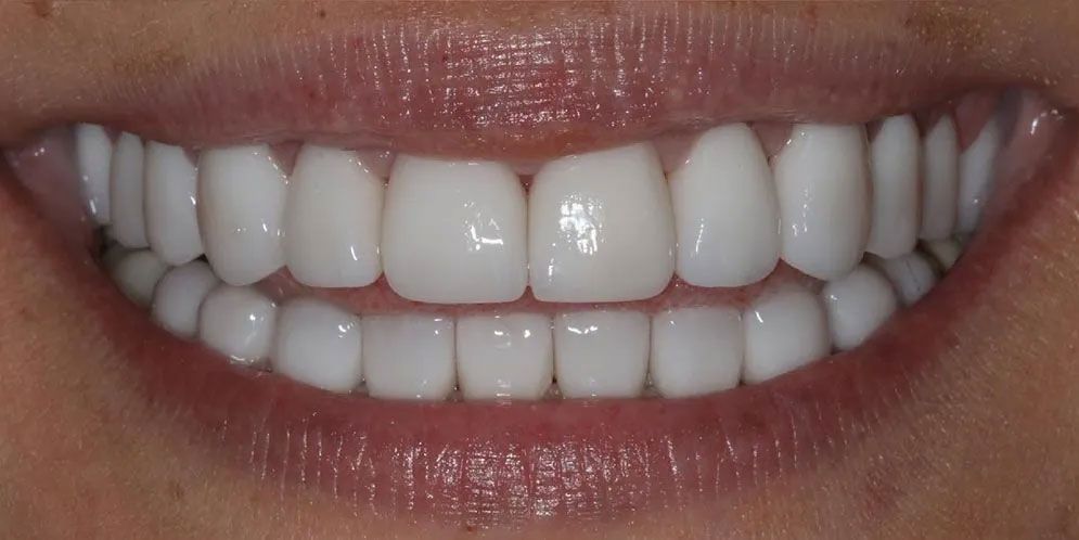 A close up of a woman 's smile with white teeth.