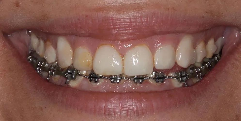 A close up of a person 's teeth with braces on them.