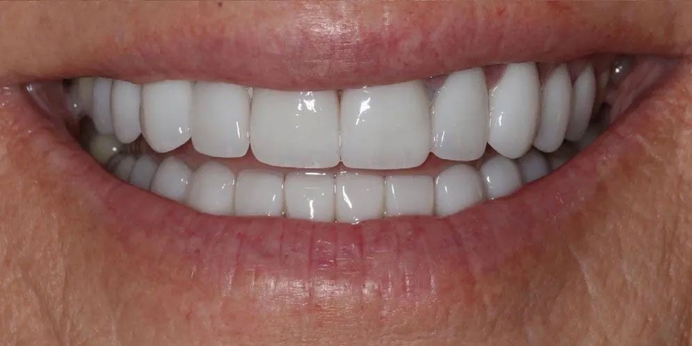 A close up of a woman 's smile with white teeth.
